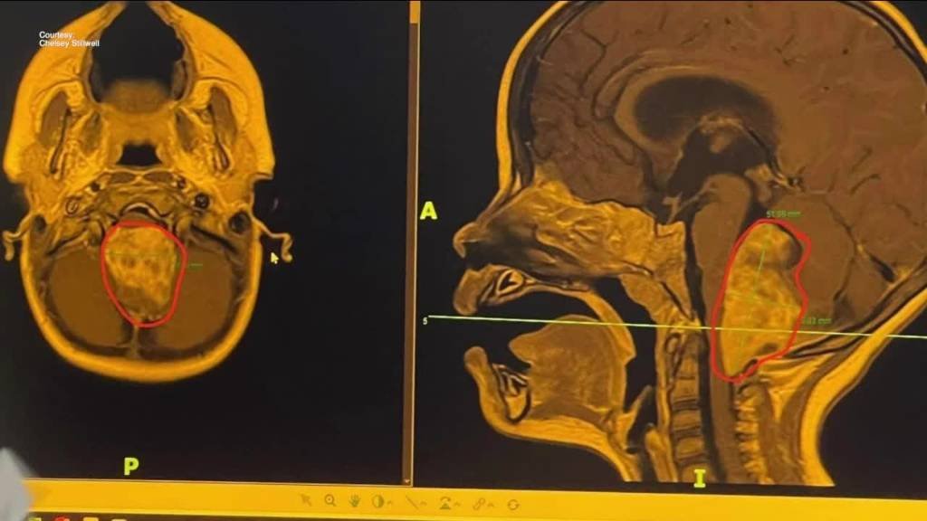 Article image for Pinellas County toddler diagnosed with golfball-sized brain tumor